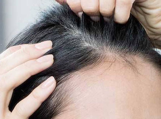 Dandruff: Causes, Symptoms, Treatment, Affect of Diabetes